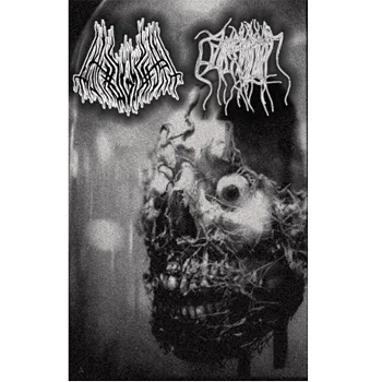 Pathogenesis / Parasitic Twin