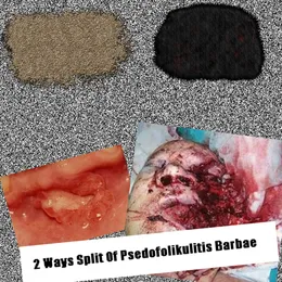 2 Ways Split Of Psedofolikulitis Barbae von SVLFVR KVFVR – Album Cover