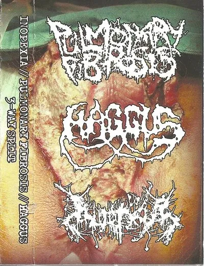 Haggus / Inopexia / Pulmonary Fibrosis