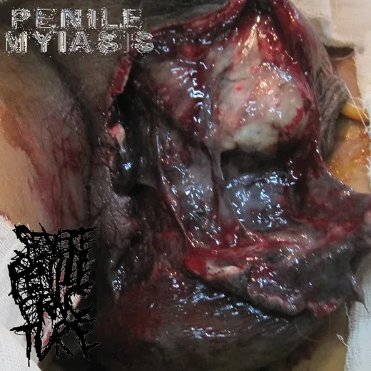 Penile Myiasis/Severe Penile Fracture Split